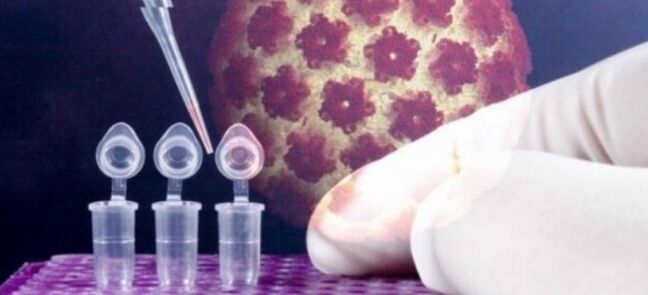 Diagnosis HPV ngagunakeun tés digene